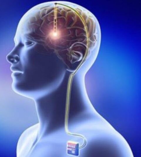 What Is Dbs Dr Liker What Is Dbs Dr Liker
